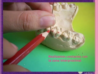 Realizamos contactos con la zona interproximalLab.Dental