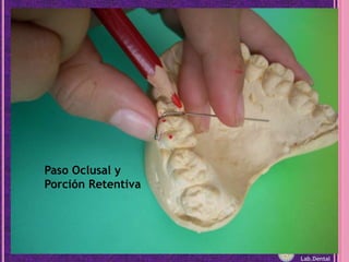 Paso Oclusal y Porción RetentivaLab.Dental