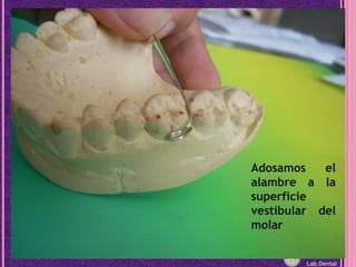 Adosamos el alambre a la superficie vestibular del molar<br />Lab.Dental<br />