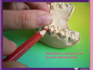 Realizamos contactos con la zona interproximal<br />Lab.Dental<br />