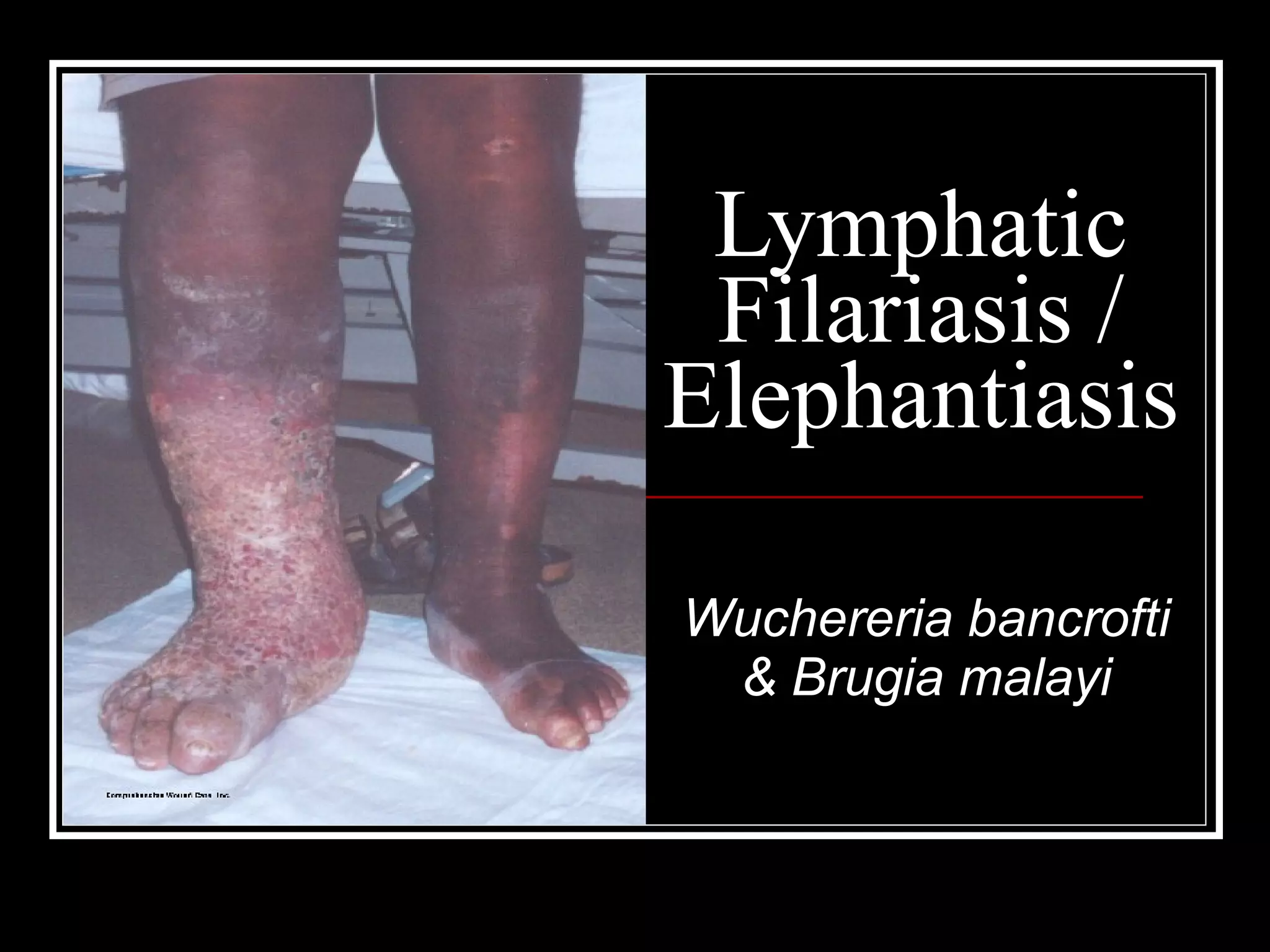 Lymphatic
Filariasis /
Elephantiasis
Wuchereria bancrofti
& Brugia malayi