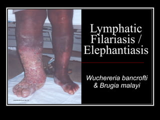 Lymphatic Filariasis / Elephantiasis Wuchereria bancrofti & Brugia malayi 