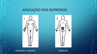 APLICAÇÃO DOS ELETRODOS
IRRITAÇÃO N. MEDIANO LOMBALGIA
 