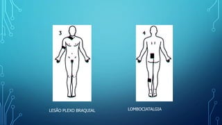 LESÃO PLEXO BRAQUIAL LOMBOCIATALGIA
 