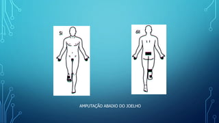 AMPUTAÇÃO ABAIXO DO JOELHO
 