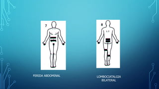 FERIDA ABDOMINAL LOMBOCIATALGIA
BILATERAL
 