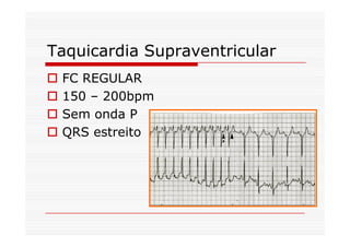 Taquicardia Supraventricular
FC REGULAR
150 – 200bpm
Sem onda P
QRS estreito
 