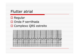 Flutter atrial
Regular
Onda P serrilhada
Complexo QRS estreito
 