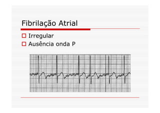 Fibrilação Atrial
Irregular
Ausência onda P
 