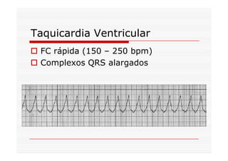 Taquicardia Ventricular
FC rápida (150 – 250 bpm)
Complexos QRS alargados
 