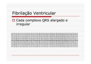 Fibrilação Ventricular
Cada complexo QRS alargado e
irregular
 