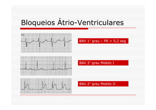 Bloqueios Átrio-Ventriculares
BAV 1° grau – PR > 0,2 seg
BAV 2° grau Mobitz I
BAV 2° grau Mobitz II
 
