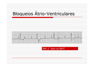 Bloqueios Átrio-Ventriculares
BAV 3 ° grau ou BAVT
 