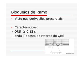 Bloqueios de Ramo
- Visto nas derivações precordiais
- Características:
- QRS ≥ 0,12 s
- onda T oposta ao retardo do QRS
 