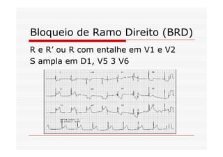 Bloqueio de Ramo Direito (BRD)
R e R’ ou R com entalhe em V1 e V2
S ampla em D1, V5 3 V6
 