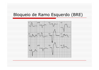Bloqueio de Ramo Esquerdo (BRE)
 