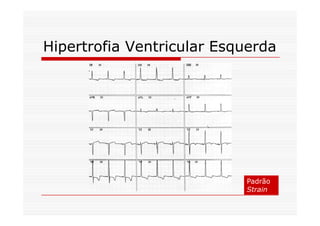 Hipertrofia Ventricular Esquerda
Padrão
Strain
 