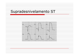 Supradesnivelamento ST
 