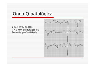 Onda Q patológica
que 25% do QRS
>1 mm de duração ou
2mm de profundidade2mm de profundidade
 