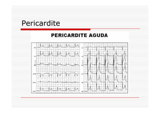 Pericardite
 