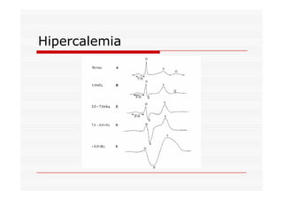 Hipercalemia
 