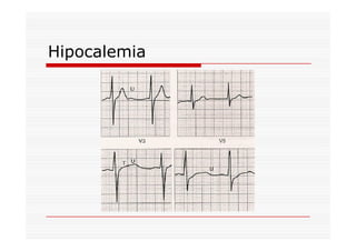 Hipocalemia
 