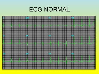 ECG NORMAL
 