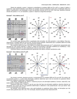 Arlindo Ugulino Netto – CARDIOLOGIA – MEDICINA P6 – 2010.1


         Depois de realizado o passo 1 (observar a polaridade do complexo QRS em DI e aVF) e o passo 2 (definir o
quadrante onde estar• localizado o eixo el€trico do cora‚ƒo), devemos especificar ainda mais a localiza‚ƒo deste eixo
el€trico, identificando a sua localiza‚ƒo a partir de intervalos menores (de 30 em 30’). Para isso, devemos continuar
atrav€s dos passos 3, 4 e, se necess•rio, o passo 5. Vejamos os seguintes exemplos:


         2                     o
Exemplo – Eixo el‹trico em 0 .




        Em primeiro lugar, devemos definir o quadrante onde se localiza, de modo grosseiro, o eixo el€trico. Para isso,
observamos o complexo QRS em DI e em aVF. No ECG acima mostrado, observamos que o complexo QRS em DI est•
muito positivo, enquanto que em aVF, est• praticamente isoel€trico.
                                                                                     o
        Da„, podemos determinar que o eixo el€trico do cora‚ƒo est• exatamente em 0 , praticamente representado pela
deriva‚ƒo DI. Isso porque segundo o “passo 4”, depois de encontrada a deriva‚ƒo isoel€trica (ou isodif•sica), o eixo
estar• localizado justamente no vetor perpendicular a ele (no caso de aVF, ser• DI).
        Indiv„duos obesos e gr•vidas geralmente apresentam eixo el€trico card„aco semelhante a este.
         3                         o   o
Exemplo – Eixo el‹trico entre 0 e 30 .




         No primeiro momento, devemos procurar o comportamento do complexo QRS em DI e em aVF. Em ambos, ele
se apresenta positivo e, a partir desta informa‚ƒo, podemos determinar que o eixo se encontra no quadrante inferior
direito (com rela‚ƒo ao observador, evidentemente).
         Logo depois, obedecendo ao “passo 3”, devemos procurar uma deriva‚ƒo isoel€trica. Contudo, neste ECG, nƒo
existe nenhum complexo QRS isoel€trico.
         Passamos entƒo para o “passo 5” que diz que caso nƒo haja uma deriva‚ƒo isoel€trica, devemos observar as
deriva‚†es que cruzam por fora do quadrante determinado e selecionar o eixo perpendicular a ele que estiver mais
pr…ximo da polaridade de DI ou aVF.
         No exemplo, como definimos que o eixo est• localizado no quadrante inferior direito, as deriva‚†es que nƒo
cruzam este quadrante sƒo: DIII e aVL. Por conven‚ƒo, devemos sempre iniciar observando DIII.

                                                                                                                        24
 