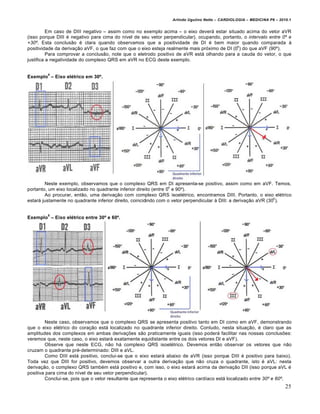 Arlindo Ugulino Netto – CARDIOLOGIA – MEDICINA P6 – 2010.1

Em caso de DIII negativo – assim como no exemplo acima – o eixo dever• estar situado acima do vetor aVR
(isso porque DIII € negativo para cima do n„vel de seu vetor perpendicular), ocupando, portanto, o intervalo entre 0º e
+30º. Esta conclusƒo € clara quando observamos que a positividade de DI € bem maior quando comparada ‰
o
positividade da deriva‚ƒo aVF, o que faz com que o eixo esteja realmente mais pr…ximo de DI (0 ) do que aVF (90’).
Para comprovar a conclusƒo, note que o eletrodo positivo de aVR est• olhando para a cauda do vetor, o que
justifica a negatividade do complexo QRS em aVR no ECG deste exemplo.
4

Exemplo – Eixo el‹trico em 30Œ.

Neste exemplo, observamos que o complexo QRS em DI apresenta-se positivo, assim como em aVF. Temos,
o
portanto, um eixo localizado no quadrante inferior direito (entre 0 e 90’).
Ao procurar, entƒo, uma deriva‚ƒo com complexo QRS isoel€trico, encontramos DIII. Portanto, o eixo el€trico
o
estar• justamente no quadrante inferior direito, coincidindo com o vetor perpendicular ‰ DIII: a deriva‚ƒo aVR (30 ).
5

Exemplo – Eixo el‹trico entre 30Œ e 60Œ.

Neste caso, observamos que o complexo QRS se apresenta positivo tanto em DI como em aVF, demonstrando
que o eixo el€trico do cora‚ƒo est• localizado no quadrante inferior direito. Contudo, nesta situa‚ƒo, € claro que as
amplitudes dos complexos em ambas deriva‚†es sƒo praticamente iguais (isso poder• facilitar nas nossas conclus†es:
veremos que, neste caso, o eixo estar• exatamente equidistante entre os dois vetores DI e aVF).
Observe que neste ECG, nƒo h• complexo QRS isoel€trico. Devemos entƒo observar os vetores que nƒo
cruzam o quadrante pr€-determinado: DIII e aVL.
Como DIII est• positivo, conclui-se que o eixo estar• abaixo de aVR (isso porque DIII € positivo para baixo).
Toda vez que DIII for positivo, devemos observar a outra deriva‚ƒo que nƒo cruza o quadrante, isto € aVL: nesta
deriva‚ƒo, o complexo QRS tamb€m est• positivo e, com isso, o eixo estar• acima da deriva‚ƒo DII (isso porque aVL €
positiva para cima do n„vel de seu vetor perpendicular).
Conclui-se, pois que o vetor resultante que representa o eixo el€trico card„aco est• localizado entre 30º e 60º.

25

 