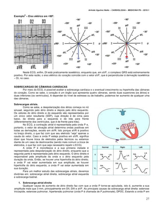 Arlindo Ugulino Netto – CARDIOLOGIA – MEDICINA P6 – 2010.1
8

Exemplo – Eixo el‹trico em +90Œ.

Neste ECG, enfim, DI est• praticamente isoel€trico, enquanto que, em aVF, o complexo QRS est• extremamente
positivo. Por esta razƒo, o eixo el€trico do cora‚ƒo coincide com o vetor aVF, que € perpendicular ‰ deriva‚ƒo isoel€trica
– DI, no caso.

SOBRECARGAS DE C•MARAS CARDˆACAS
Por meio do ECG, € poss„vel avaliar a sobrecarga card„aca e o eventual crescimento ou hipertrofia das cŠmaras
do cora‚ƒo. Como se sabe, o cora‚ƒo € um …rgƒo que apresenta quatro cŠmaras, sendo duas superiores (os •trios) e
duas inferiores (os ventr„culos). A depender do n„vel de estresse ou de trabalho, podemos ter aumento de qualquer uma
das cŠmaras.
Sobrecargas atriais.
Como se sabe, a despolariza‚ƒo dos •trios come‚a no n…
sinusal, seguindo pelo •trio direito e depois pelo •trio esquerdo.
Os vetores do •trio direito e do esquerdo sƒo representados por
um ‹nico vetor resultante (S“P), cuja dire‚ƒo € de cima para
baixo, da direita para a esquerda e de tr•s para frente
(diferentemente dos ventr„culos, que € de frente para tr•s).
No ECG, a contra‚ƒo atrial € representada pela onda P e,
portanto, o vetor de ativa‚ƒo atrial determina ondas positivas em
todas as deriva‚†es, exceto em aVR. Isto porque aVR € positivo
no bra‚o direito, o que faz com que seu eletrodo “veja” apenas a
cauda do vetor. Caso a onda P esteja positiva em aVR, significa
dizer que houve troca de eletrodos pelos t€cnicos ou estamos
diante de um caso de dextrocardia (sendo mais comum a troca de
eletrodos, o que faz com que seja necess•rio repetir o ECG).
A onda P € monof•sica e a sua primeira metade €
representada pela despolariza‚ƒo do •trio direito, enquanto que a
segunda parte € representada pelo •trio esquerdo. O •trio direito €
respons•vel pela amplitude da onda e o •trio esquerdo pela
dura‚ƒo da onda. Entƒo, se houver uma hipertrofia do •trio direito,
a onda P vai estar aumentada em sua amplitude; se houver
hipertrofia do •trio esquerdo, a onda P vai estar aumentada em
sua dura‚ƒo.
Para um melhor estudo das sobrecargas atriais, devemos
dividi-las em: sobrecarga atrial direita, sobrecarga atrial esquerda
e sobrecarga biatrial.
1. Sobrecarga atrial direita
Qualquer causa de aumento de •trio direito faz com que a onda P torne-se apiculada, isto €, aumente a sua
amplitude mais que 3 mm, principalmente em DII, DIII e aVF. As principais causas da sobrecarga atrial direita: estenose
tric‹spide, estenose pulmonar, hipertensƒo pulmonar (onda P € chamada de P pulmonale), DPOC. Estando a onda P em

27

 