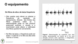 O equipamento
Os filtros de alta e de baixa frequência
• São usados para elevar ou abaixar a
frequência de captação do
equipamento. Através dos limites dos
filtros podemos saber se o
eletromiógrafo pode ou não produzir
potenciais audíveis e visuais e o
examinador pode alterar a calibração
dos filtros quando for conveniente.
• No filtro de baixa, a frequência pode ser
entre 1 e 200 Hz e no filtro de alta entre
100 Hz e 10 kHz.
Figura1: Eletromiografia de superfície com dois
canais, demonstrando um tremor de 6 Hz com
ativação síncrona entre agonistas e antagonistas,
característica de um tremor essencial.
03/10/2017 Eletroneuromiografia 10
 