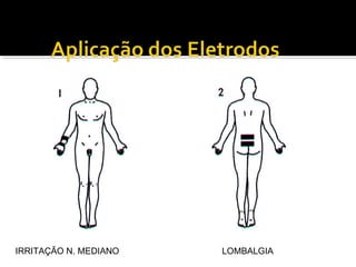 IRRITAÇÃO N. MEDIANO LOMBALGIA 
 