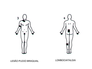 LESÃO PLEXO BRAQUIAL LOMBOCIATALGIA 
 