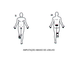 AMPUTAÇÃO ABAIXO DO JOELHO 
 