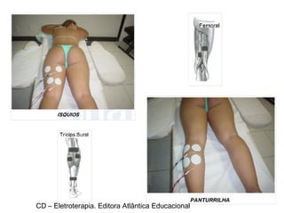 CD – Eletroterapia. Editora Atlântica Educacional 
 