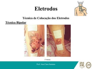 Eletrodos
Técnica de Colocação dos Eletrodos
Técnica Bipolar
Prof. Ana Clara Santana
 