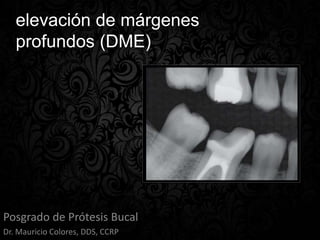 elevación de márgenes
profundos (DME)
Posgrado de Prótesis Bucal
Dr. Mauricio Colores, DDS, CCRP
 