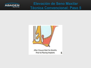 Elevación de Seno Maxilar
Técnica Convencional: Paso 5