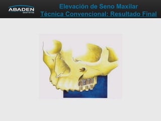 Elevación de Seno Maxilar
Técnica Convencional: Resultado Final