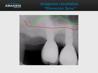 Imágenes resultados
“Elevación Seno”