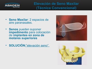 Elevación de Seno Maxilar
(Técnica Convencional)
• Seno Maxilar: 2 espacios de
aire paranasales.
• Senos pueden suponer
impedimento para colocación
de implantes en zona de
molares superiores
• SOLUCIÓN:”elevación seno”.