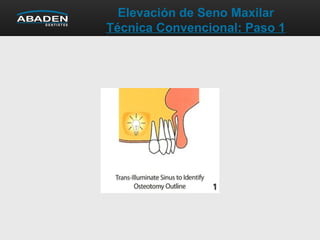 Elevación de Seno Maxilar
Técnica Convencional: Paso 1