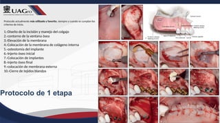 Protocolo de 1 etapa
Protocolo actualmente más utilizado y favorito, siempre y cuando se cumplan los
criterios de inicio.
1.-Diseño de la incisión y manejo del colgajo
2.-contorno de la ventana ósea
3.-Elevación de la membrana
4.-Colocación de la membrana de colágeno interna
5.-osteotomía del implante
6.-Injerto óseo inicial
7.-Colocación de implantes
8.-injerto óseo final
9.-colocación de membrana externa
10.-Cierre de tejidos blandos
 