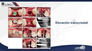 Elevación transcrestal
 