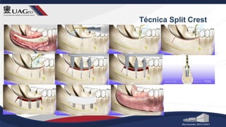 Técnica Split Crest
 