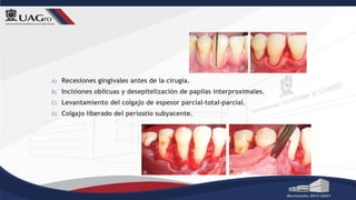 A) Recesiones gingivales antes de la cirugía.
B) Incisiones oblicuas y desepitelización de papilas interproximales.
C) Levantamiento del colgajo de espesor parcial-total-parcial.
D) Colgajo liberado del periostio subyacente.
 