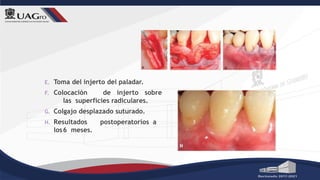 E. Toma del injerto del paladar.
F. Colocación de injerto sobre
las superficies radiculares.
G. Colgajo desplazado suturado.
H. Resultados postoperatorios a
los6 meses.
 