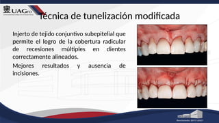 Técnica de tunelización modificada
Injerto de tejido conjuntivo subepitelial que
permite el logro de la cobertura radicular
de recesiones múltiples en dientes
correctamente alineados.
Mejores resultados y ausencia de
incisiones.
 