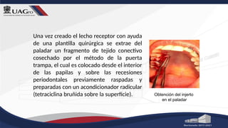 Una vez creado el lecho receptor con ayuda
de una plantilla quirúrgica se extrae del
paladar un fragmento de tejido conectivo
cosechado por el método de la puerta
trampa, el cual es colocado desde el interior
de las papilas y sobre las recesiones
periodontales previamente raspadas y
preparadas con un acondicionador radicular
(tetraciclina bruñida sobre la superficie). Obtención del injerto
en el paladar
 