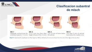 Clasificacion subantral
de misch
 